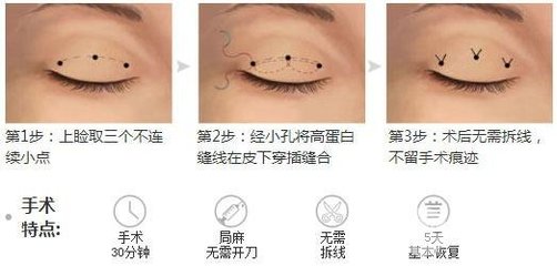 埋线双眼皮拆线疼吗