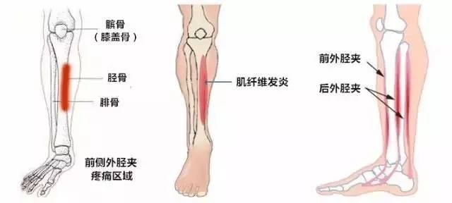 腓骨痛是怎么回事