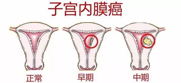宫颈息肉会影响胎儿吗