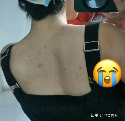 背部为什么好多痘痘