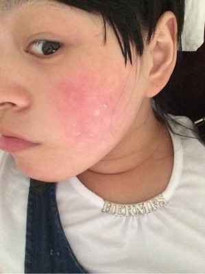 脸过敏痘痘