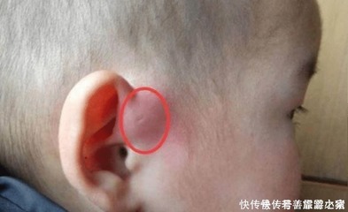 耳朵有个小孔是怎么回事