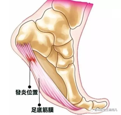 跖筋膜炎怎么治疗