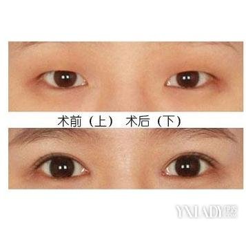 下眼皮凹陷修复哪里好
