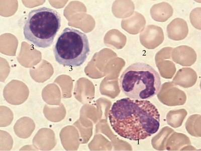 尿红细胞形态学指标怎么看