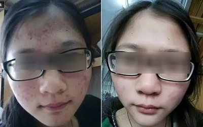 痘痘有周期吗