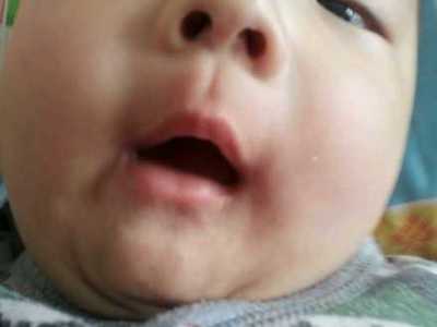 嘴边小痘痘是怎么回事啊
