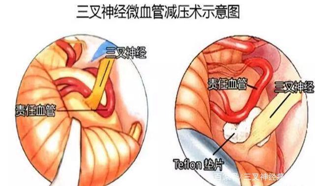 三叉神经疼是怎么回事