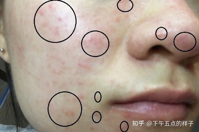 上火 痘痘 为什么