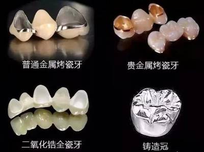 烤瓷牙和全瓷牙哪种好