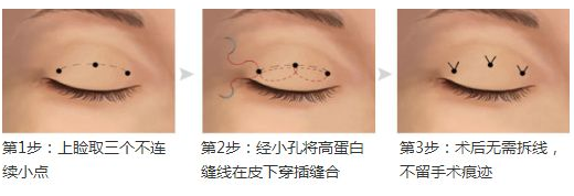 曲靖埋线双眼皮