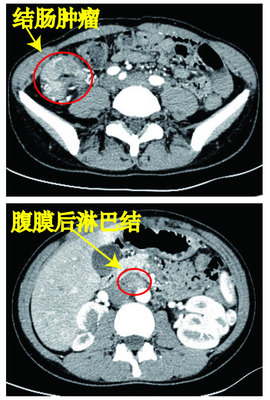 小孩肠系膜淋巴结肿大怎么治疗