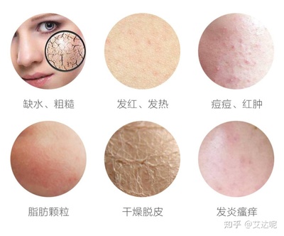 敏感痘痘肌护肤品