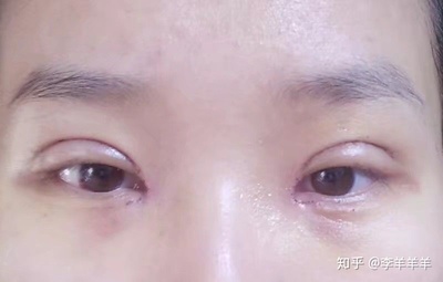 双眼皮结疤