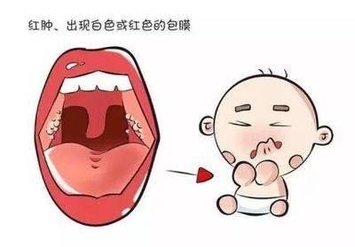 一岁宝宝喉咙发炎发烧怎么办