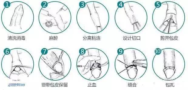 手动包皮粘连分离清洗多少钱