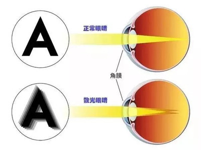 眼睛有重影是怎么回事