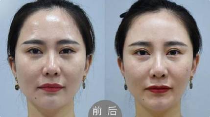 玻尿酸填充面颊