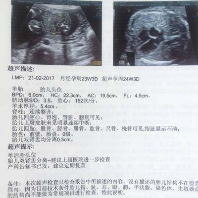 胎儿肾盂分离是什么意思