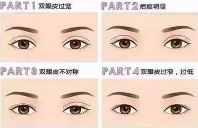 双眼皮做修复