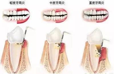 牙齿咬东西酸软无力怎么治疗