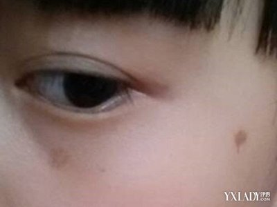 点痣留下的疤能消失吗