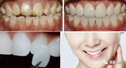 牙齿光固美白