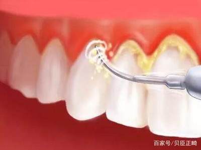 多长时间洗一次牙比较好