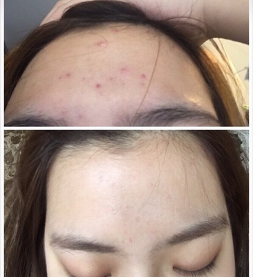 额头小痘痘什么原因