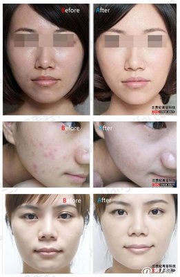 眉间粉刺是什么原因