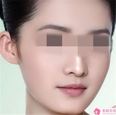 分体式隆鼻