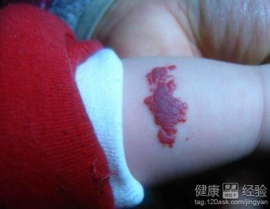 面部血管瘤可以根治吗,眼底血管瘤可以根治吗