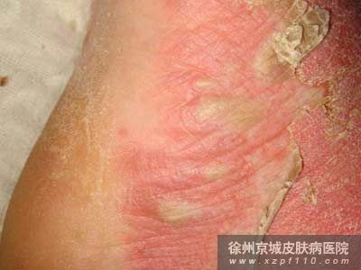 牛皮癣怎么治疗好