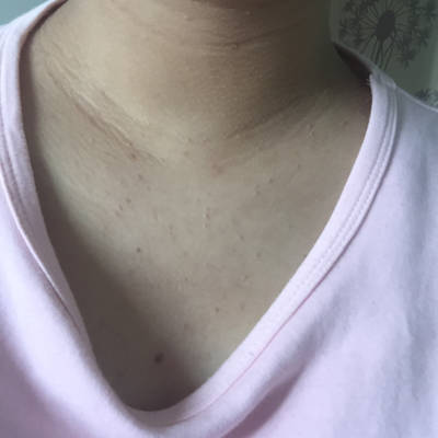 胸口都是痘痘