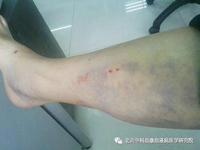 身体很容易淤青是怎么回事