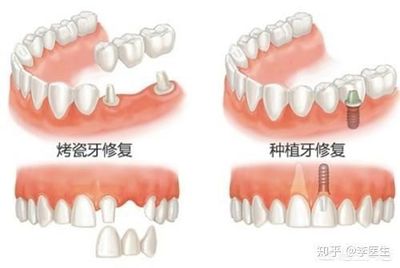 牙根没了能做烤瓷牙吗