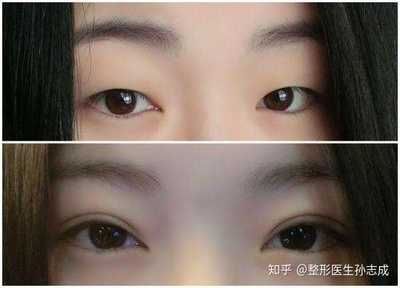 埋线双眼皮多久恢复正常