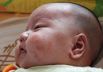 初生婴儿湿疹怎么治疗