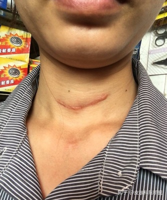 颈部结节怎么治疗