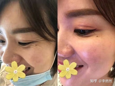 玻尿酸能打哪里