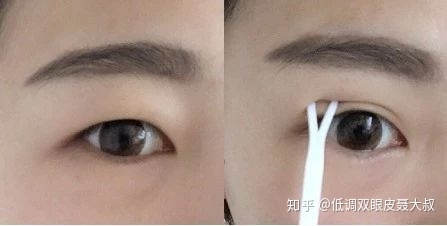 可以割一个双眼皮吗