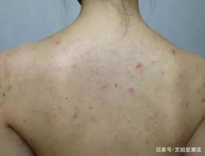 后背全身起痘痘是怎么回事