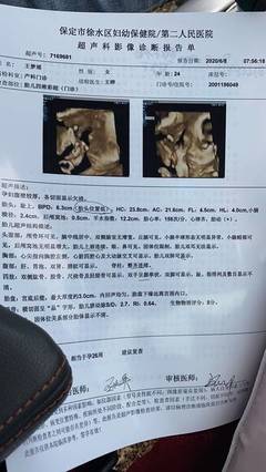 胎儿头偏大是什么原因