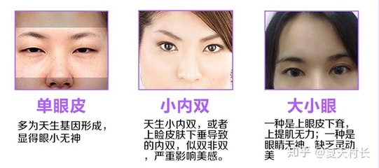 内双算双眼皮基因吗