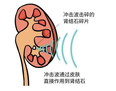 宝宝肾结石有什么症状