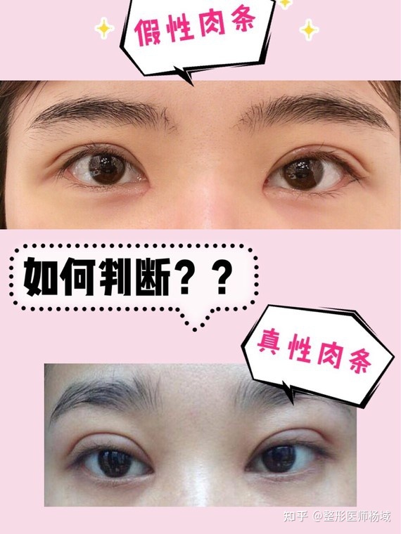 双眼皮疤痕多久才淡化