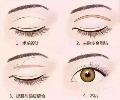 做双眼皮的禁忌