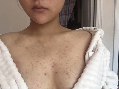 怀孕背部长痘痘怎么办