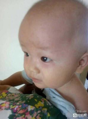 七个月宝宝反复发烧怎么办