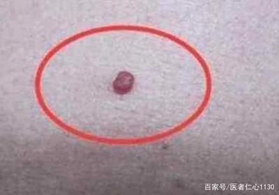 肝上有黑点是怎么回事